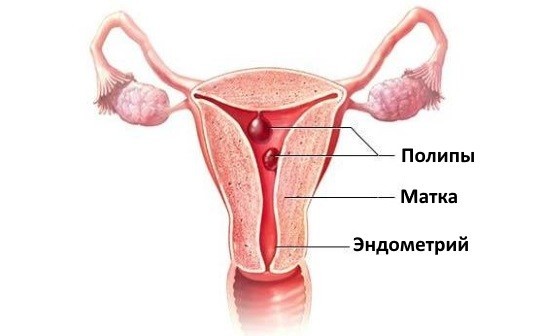 Папиллома у женщин гинекология