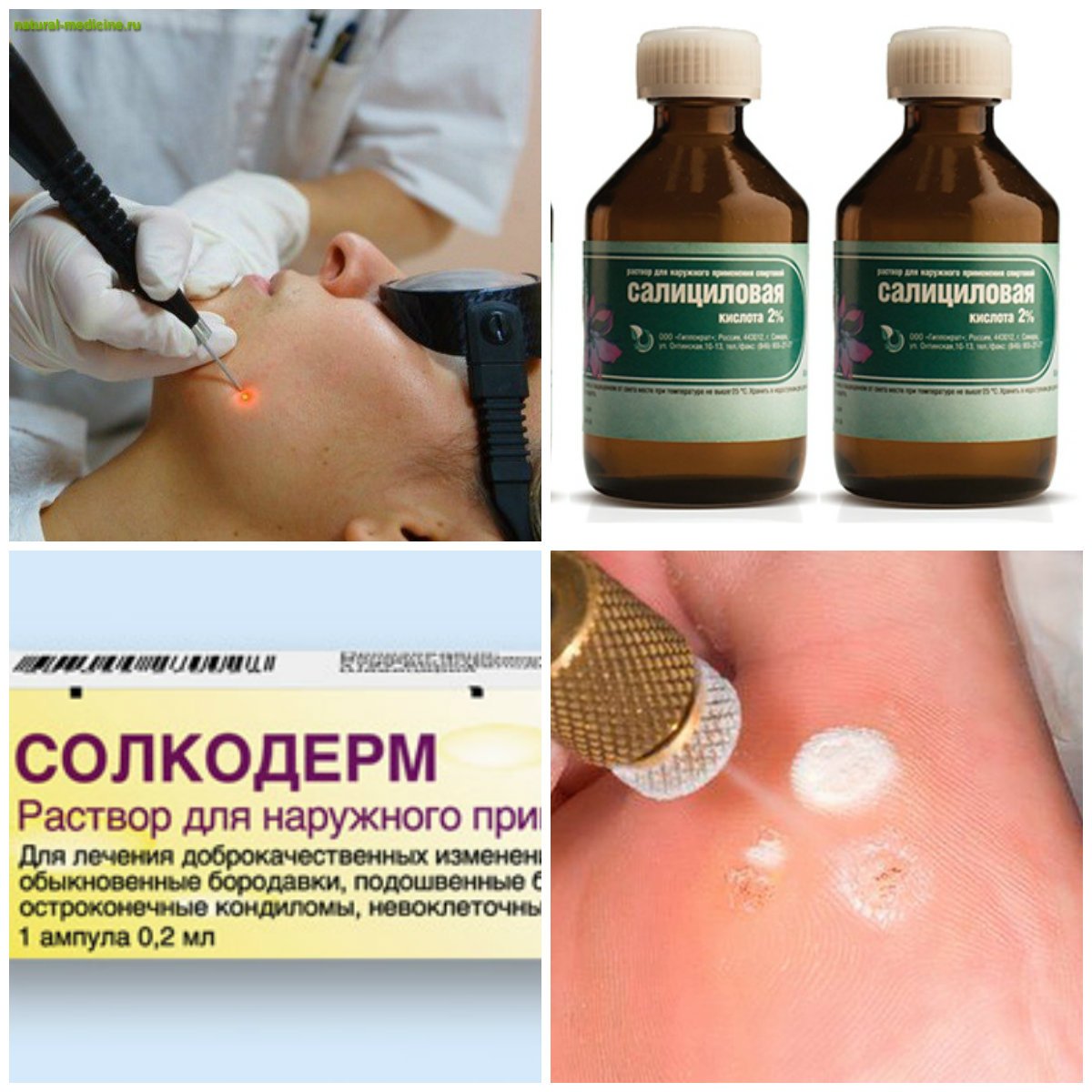 Как удалять бородавки уксусной кислотой Как удалять бородавки уксусной кислотой