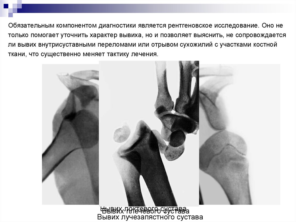 Патологические движения в суставах Патологические движения в суставах