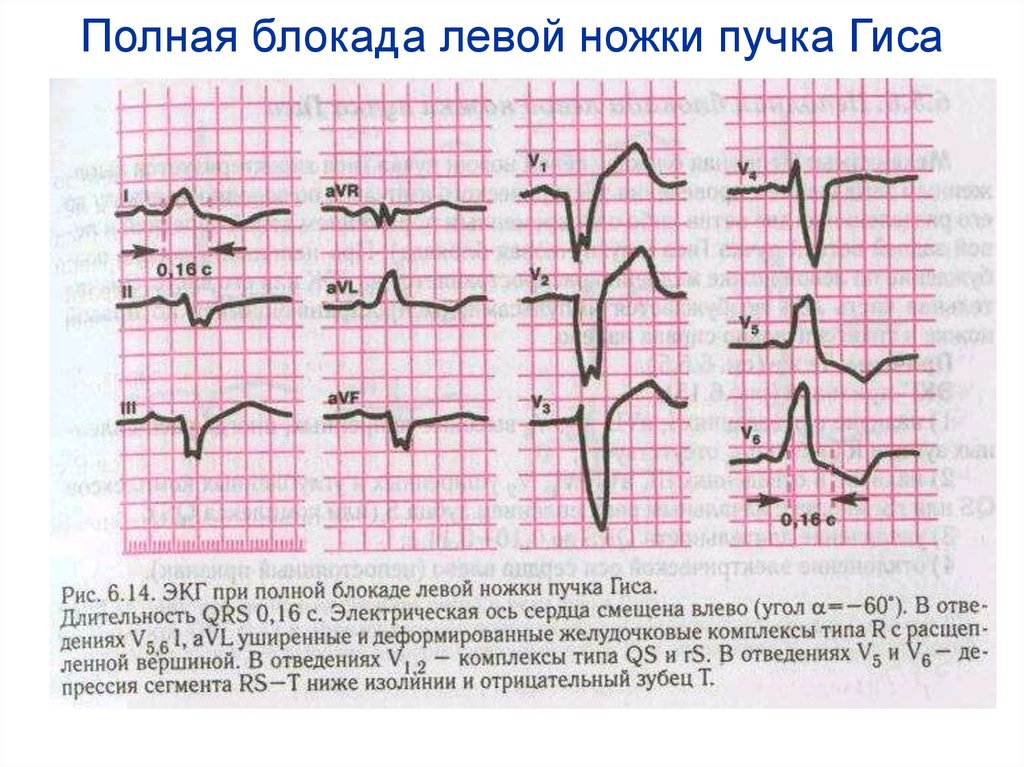 Лечение при полной блокады пучка гиса правой ножки пучка гиса Глава 3. Дисциплинарная ответственность адвокатов