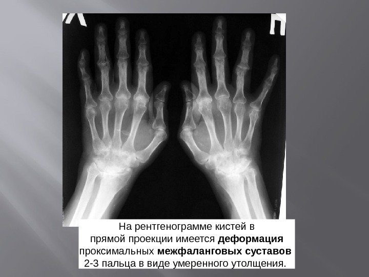 Артрите межфаланговых суставов кистей Артрите межфаланговых суставов кистей