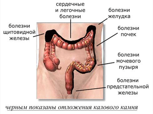 Лечение боли кишечника в домашних условиях Лечение боли кишечника в домашних условиях