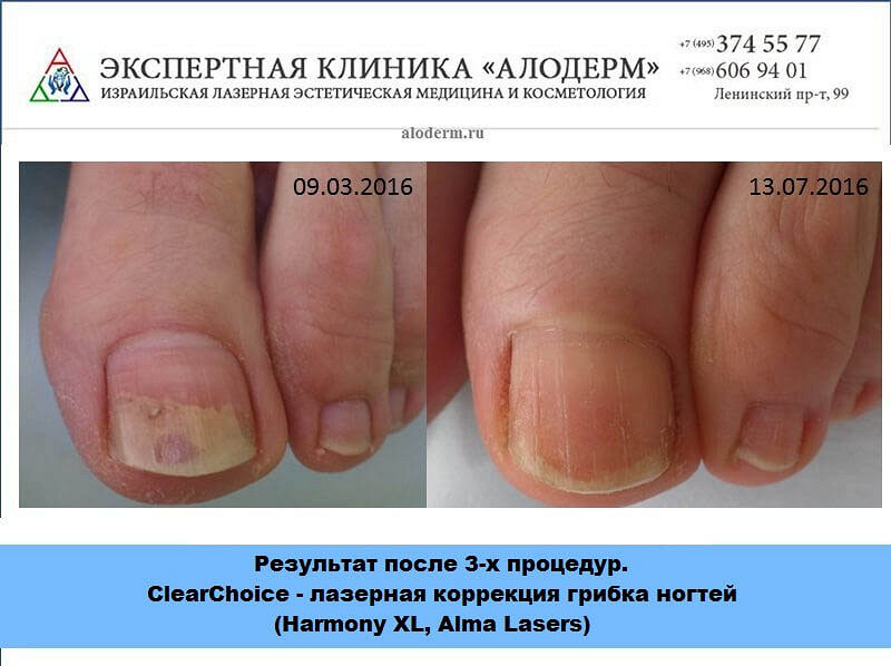 Грибок ногтей на ногах стадии как лечат Грибок ногтей на ногах стадии как лечат
