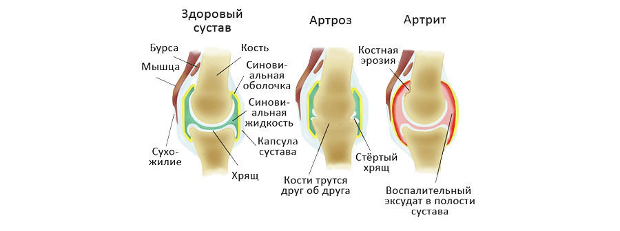 Бурсит тазобедренного сустава Боль в яичках у мужчин: причины появления, признаки, при