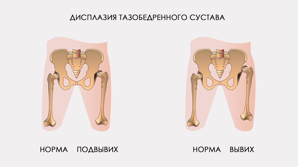 Дисплазия болит сустав Дисплазия болит сустав