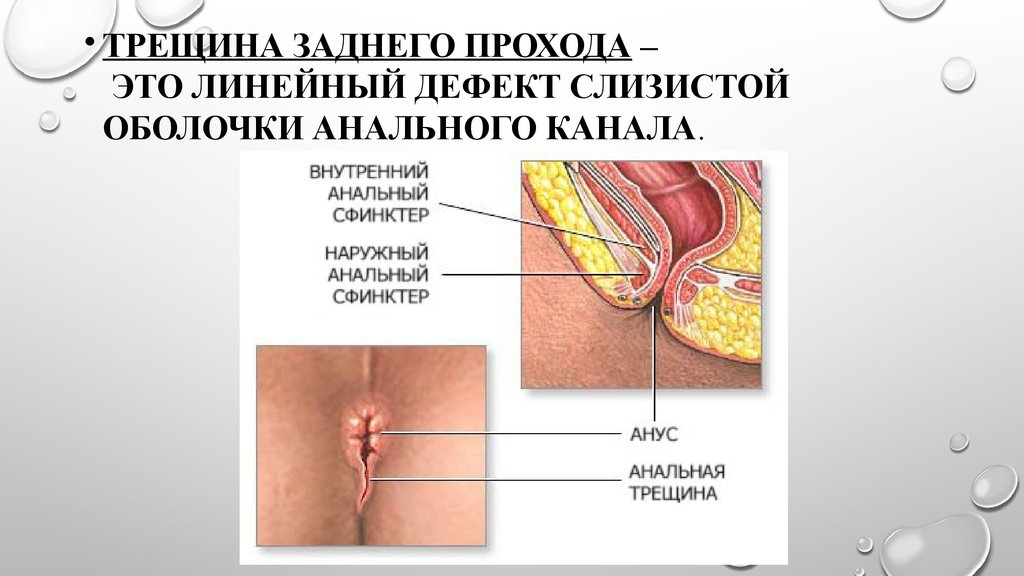 Как в домашних условиях вылечить трещину заднего прохода Как в домашних условиях вылечить трещину заднего прохода