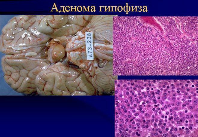 Лечение аденомы простаты у мужчин: альфа-блокаторы, свечи и Лейкоциты в простате норма