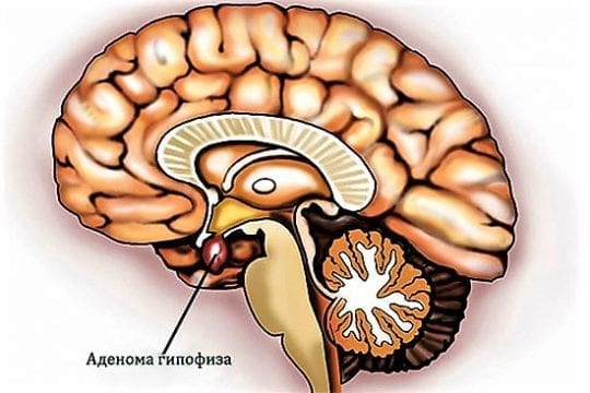 Аденома гипофиза месячные Аденома гипофиза месячные