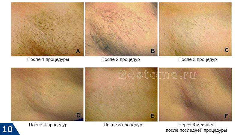 Процедура эпиляция глубокое бикини Процедура эпиляция глубокое бикини