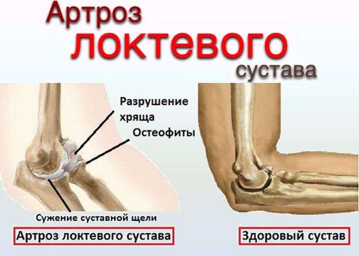Ревматоидный артрита в домашних условиях 985