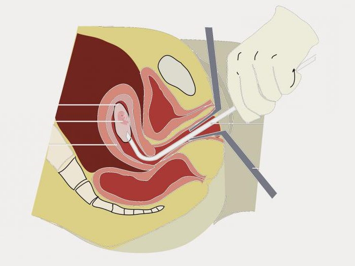Что такое биопсия матки в гинекологии