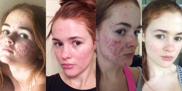 Accutane where to buy in uk