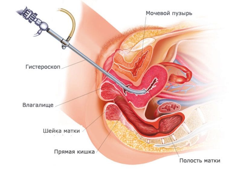 Операция по гинекологии удаления матки