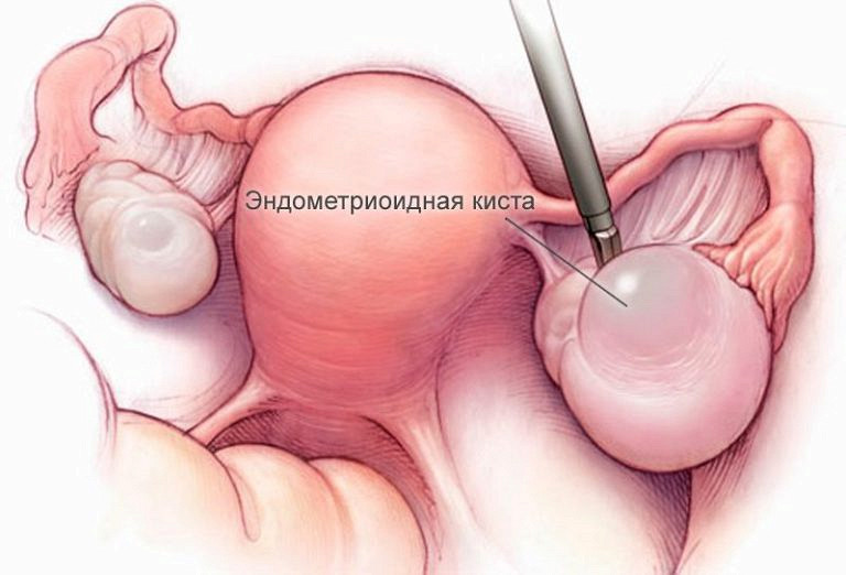 Магнезия в гинекологии при кисте яичника