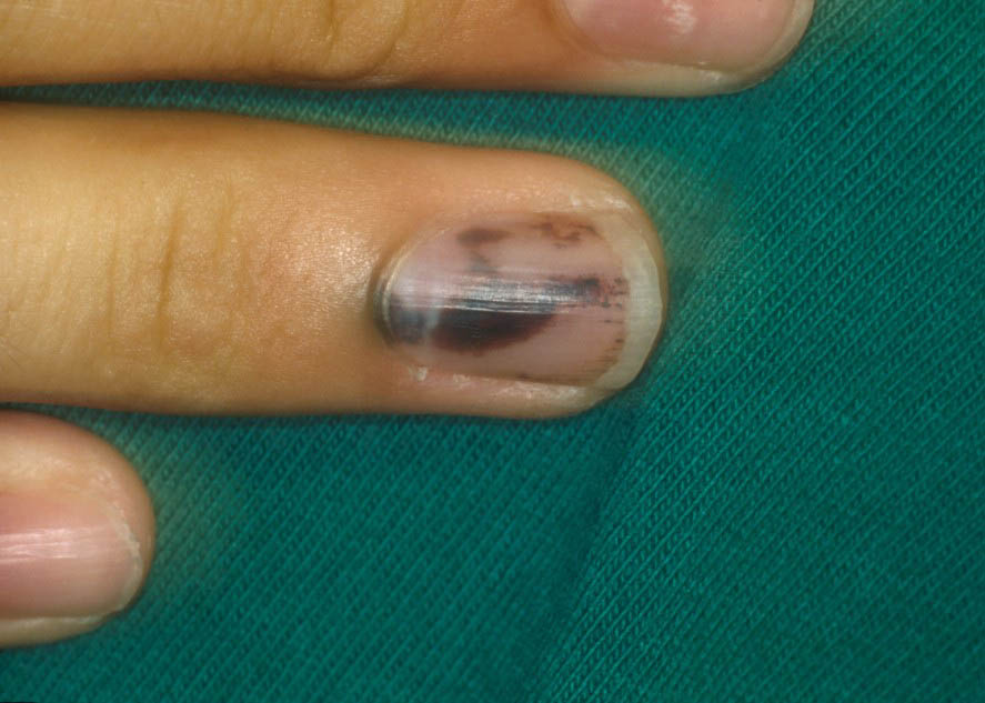 Грибок ногтей черного цвета грибок ногтей - как вылечить гри.
